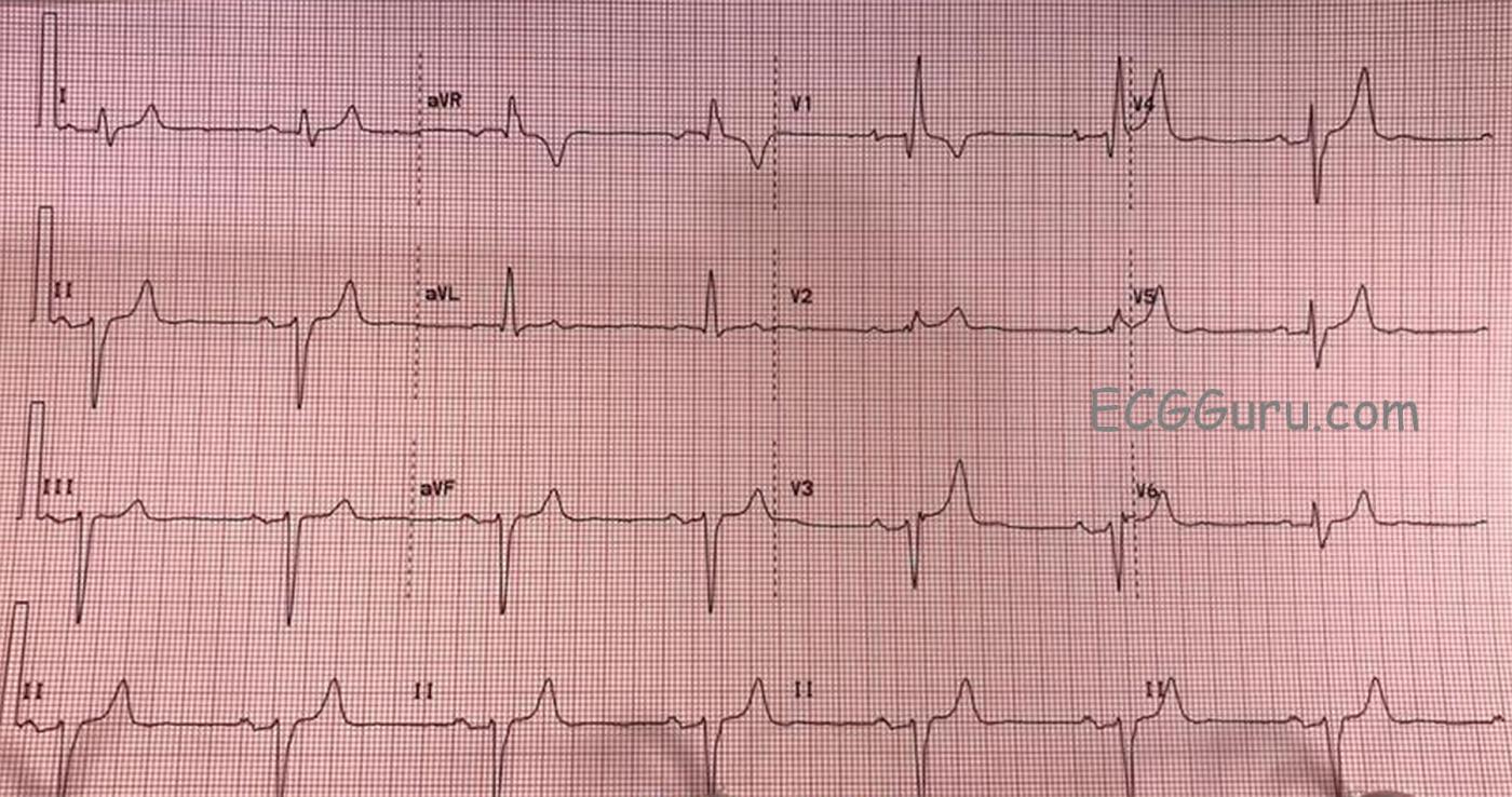 Bifascicular Block and Sinus Bradycardia ECG Guru Instructor Resources